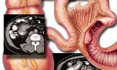 U carcinoid - một dạng ung thư đặc biệt